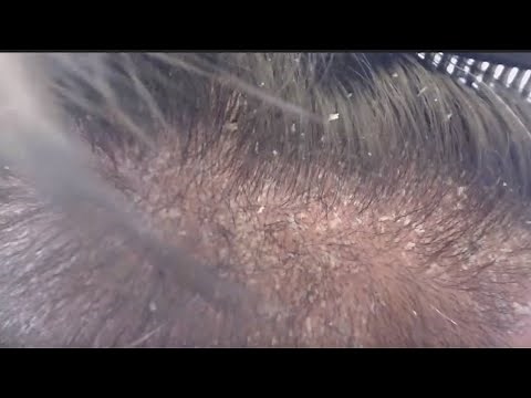 SCALP PSORIASIS - I REALLY SHOULD JUST SHAVE MY HEAD.