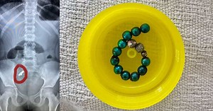 S'pore girl, 9, punctured small intestine after swallowing 14 magnetic balls