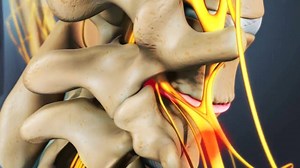 Bony growths, known as bone spurs, or lumbar osteophytes, may develop on the spine as a result of aging or injury. They may or may not cause symptoms. To learn more, watch the full video: http://www.spine-health.com/video/lumbar-osteophytes-bone-spurs-video | Spine-health