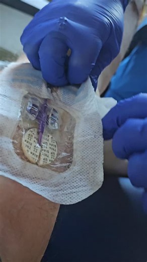 Nick Scott on Instagram: "⚠️ If you’re squeamish, don’t watch… ⚠️ I just got my PICC line removed — a long, thin tube 20–24 inches (50–60 cm) long. It was inserted into a vein in my upper arm and threaded all the way to a major vein near my heart… where the tube ends. 💉 Today marks 6 weeks since my surgery. This is the beginning of me finally getting out of the hospital. 1 week to go. ⏳️"