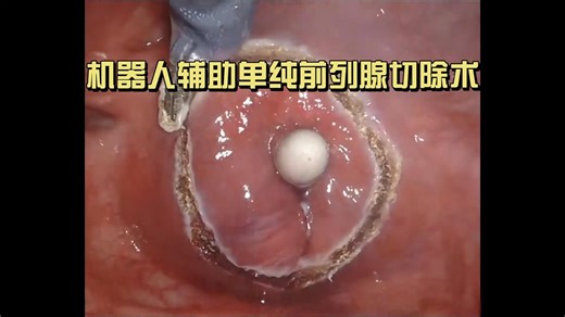 前列腺切除术（非医学相关专业慎入）