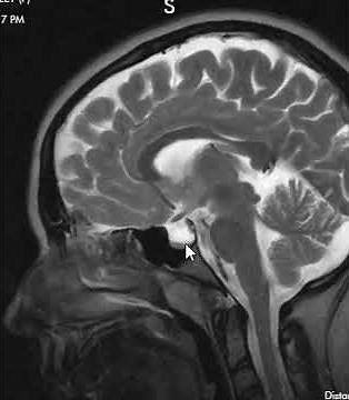 Pseudotumor Cerebri - Brain Scan MRI
