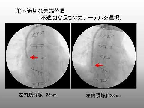 令和2年アクセス医学会 カフ型カテーテルの適切な先端位置の考え方と先端形状の変遷