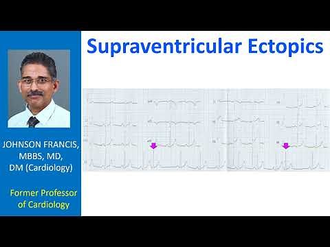 Supraventricular Ectopics