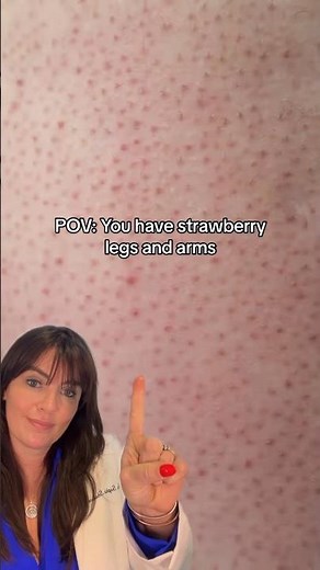 How to tackle strawberry legs/arms #strawberry #keratosispilaris #dermatologist #skincarecommunity
