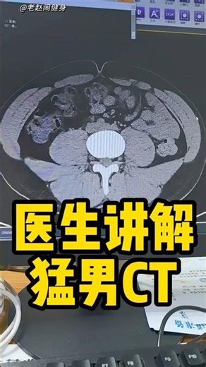 Doctor explains CT scan of a muscular man #fitness #bodybuilding #weightlifting #muscle #powerlif...