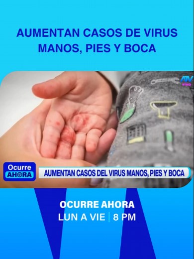 Virus manos, pies y boca: cómo prevenir el contagio