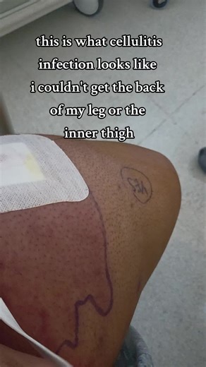 Understanding Cellulitis Infection and Its Treatment