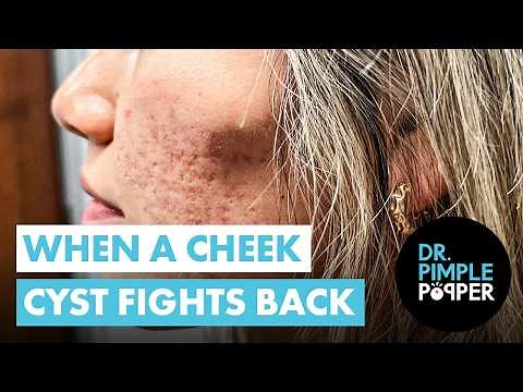 When a Cheeky Cyst Fights Back