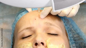 Skin care beauty concept. Close up of female client in a clinic of Beauty therapy. forehead botox injection. Face treatment procedure. 4k