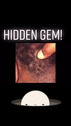 Hidden Juicy Gem! #zit #zitpopping #pimple #nasty #acne #fy #fypシ #espinillas #juicy #gross