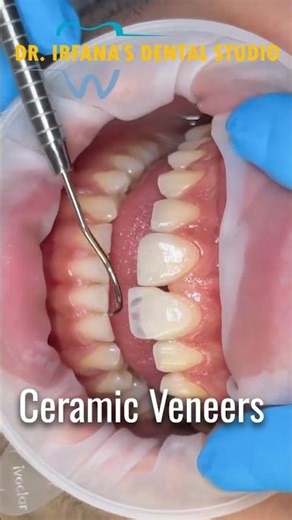 Close Teeth Gaps Instantly with Ceramic Veneers | Dr. Irfana’s Dental Studio