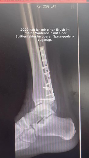 Innovative Kniebandage für Wanderer: Komfort & Unterstützung