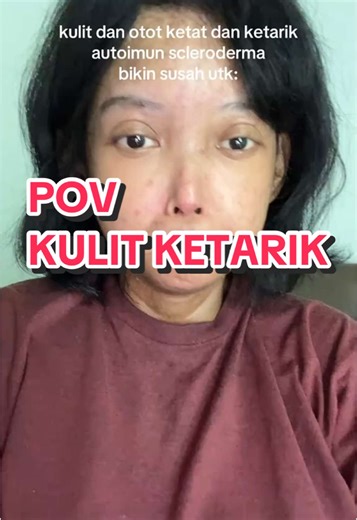 Scleroderma: Tantangan Sehari-hari dengan Penyakit Autoimun