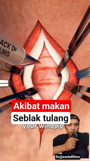 Seorang ibu kesusahan nafas akibat keselek seblak tulang #doctor #satisfying #hospital #science