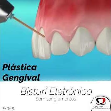Gengivoplastia com Bisturí Eletrônico - Sem sangramentos e sem Dor | Dentista em Fortaleza |