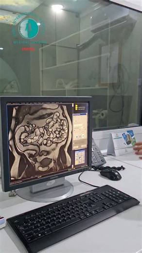 eih.medical.imaging.center on Instagram‎: "● MR Enterography وێـنەیەکـــــی ڕوونتر .... چارەســـەرێکـی زووتر .... ● کوردی / عربي/ English (بەشی تیشک) لە (نەخۆشخانەی اربیل انترناشنال ) بە پێشکەوتووترین ئامێری پشکنینی سەردەم ٢٤ کاژمێری رۆژ له ٧ رۆژی هەفتە کراوەیە بە گونجاوترین نرخ بەبێ گۆڕانی نرخ . ✅ ١. ئامێری لەرەرەی موگناتیسی . ✅ ٢. ئامێری سیتی سکان. ✅ ٣. ئامێری تیشکی دیجیتاڵی. ✅ ٤. پشکنینی چری ئێسک. ✅ ٥.پشکنینی تیشکی مەمک . ✅ ٦. پشکنینی فەرمانەکانی هەرس و میزەرۆ . ✅ ٧. ئامێری سۆناری پێشکەوتوو.