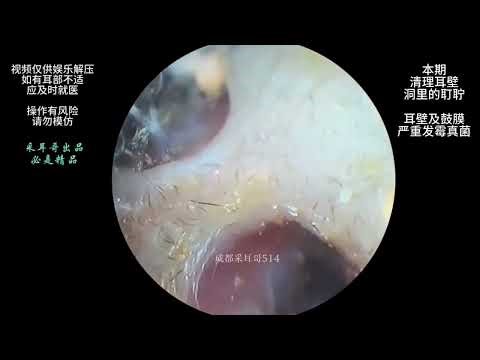 ASMR: Deep Earwax Cleaning | Relaxing Sounds