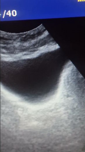 Thulep. Enucleazione prostatica con laser al tullio #prostateenlargement #bph #prostatetreatment