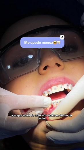 Me quede mueca y es que se cumplio uno de mis miedos más grandes 🥺🦷 pero gracias a @ortodonciajessicabastt vamos a cerrar ese huevo con ortodoncia ☺️ así que si están en busqueda de una clinica donde iniciar su tratamiento les recomiendo @Dentismart me ha gustado mucho lo que llevamos del proceso 🩵 #dientedeleche #odontologia #odontologo #brackets #bracketsbogota #ortodoncia #adultocondientedeleche #mueca