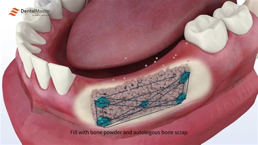 dentalmaster | The tenting screws, upgraded in collaboration with Dr. JUN LI, are developed based on clinical feedback. The added micro-hole design... | Instagram
