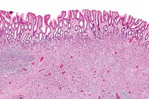 Inflammatory fibroid polyp - Alchetron, the free social encyclopedia