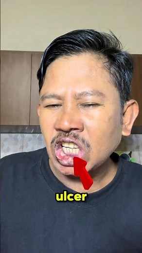 😱How to treat a mouth ulcer