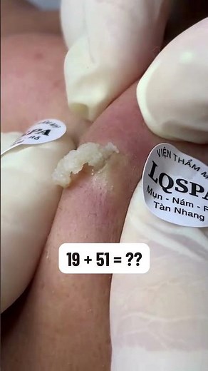 Blackheads 2026 newest dr pimple popping videos Ep 01