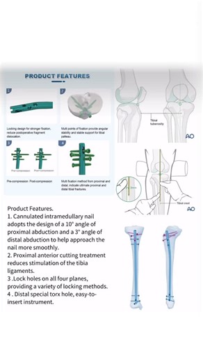 Kshitij Badade | Orthopedic Implants : Tibial IM Nail = Pure Geometrical Alignment AO checklist • Medial to lateral tibial spine • ~3 mm medial to tibial... | Instagram