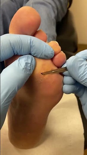 Satisfying Thick Callus Removal by Expert Podiatrist #FootCare #OddlySatisfying