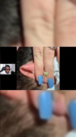LOOK AT THIS HUGE PIMPLE POP AND EXPLODE! 💥🌋