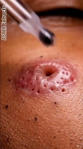 ASMR Extracts | Satisfying Blackhead Removal