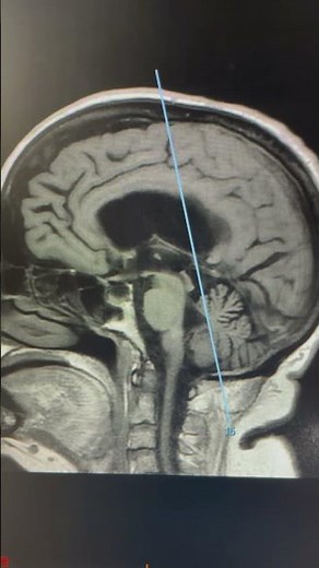 Normal pressure hydrocephalus and its diagnosis on cranial magnetic resonance imaging
