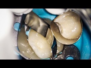 Dentist Filling a Cavity in Baby Teeth (Tooth Decay at 16x Magnification)