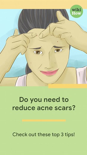 Do you want to reduce the appearance of your acne scars? Check out these top 3 tips! #howto #reduceacnescars #acnescars #acne #topicaltreatments #exfoliate #microneedling #dermafillers #skincare #health