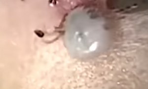 Digging deep: Doctor pulls live tick from inside man's ear