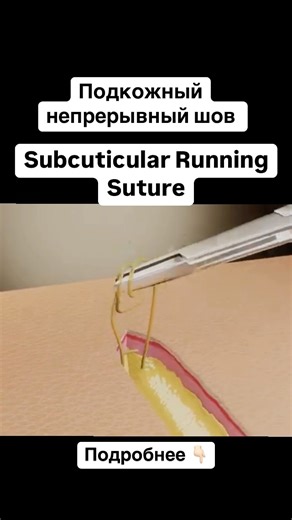 SURGEON ASMO | Hijabi Surgeon| Jawline Architect | Subcuticular Running Suture is a continuous suture technique placed in the dermal layer, just beneath the skin surface. It is commonly used... | Instagram