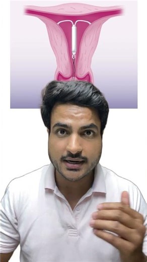 Mirena-IUD #mbbs #mbbsmotivation #mbbsstudent #mbbslife #gynecology #obgyn #contraceptives