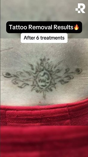 Bye lower back tattoo, hello freedom👋 #removery