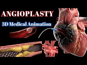 Angioplasty Explained | How Blocked Arteries Are Opened to Save Lives (3D Animation)