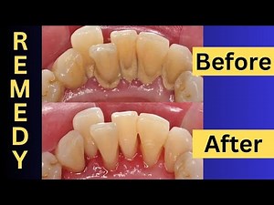 Naturally Remove Dental Plaque At Home: Easy Tips And Tricks!