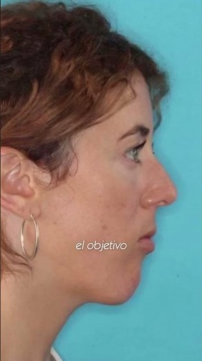 Orthognathic Surgery: Structural Facial Change