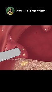 ASMR Animation | Get Rid of Bad Breath! Tonsil Stone Removal! | Meng's Stop Motion #asmr #stressrelieving | Meng's Stop Motion