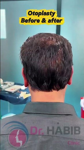 Watch this Otoplasty👂 before and right after surgery. See the difference fell the difference😳💯
