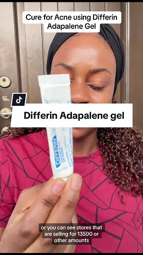 Effective Acne Treatment with Differin Adapalene Gel