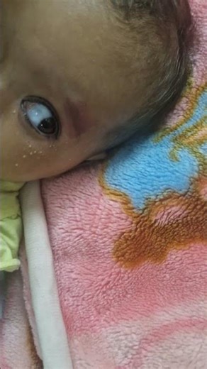 Portwine stain in sturge weber syndrome | infant with focal seizures