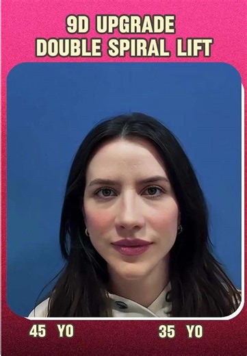 This 45-year-old French woman from France 🇫🇷 underwent the Double Helix Lifting treatment—non-surgical, no thread lifting, no recovery time, and noticeably firmer skin in just 40 minutes, making her look 10 years younger! Results may vary! Her friends exclaimed,