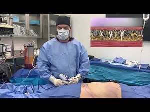 J-Plasma Abdominal Skin Tightening | Renuvion | Elite Plastic Surgery