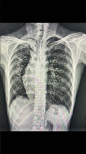 Not Dextrocardia Chest X-ray Case #shorts