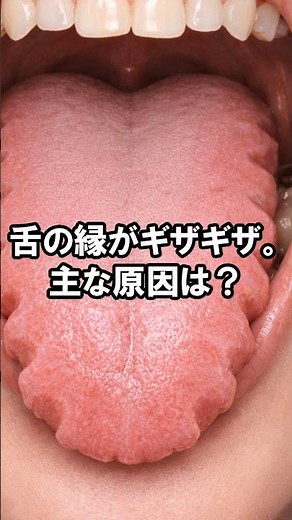 【歯の雑学480】舌の縁がギザギザ。主な原因は？ ＃クイズ ＃歯科 ＃雑学 #豆知識